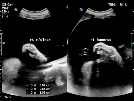 Limb shortening and typical facial features become apparent >22 weeks’ gestation. . Indicators for dwarfism on ultrasound